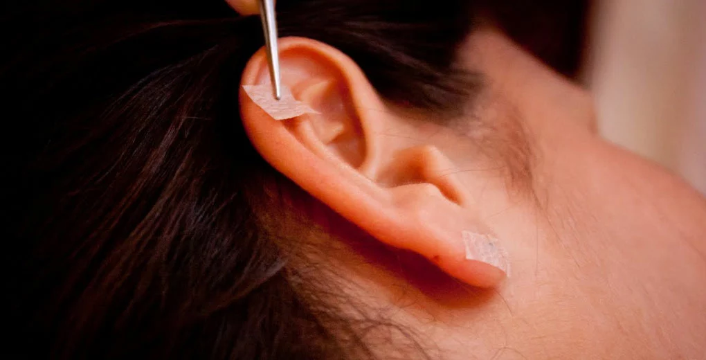 Auriculoterapia: a terapia feita através da orelha